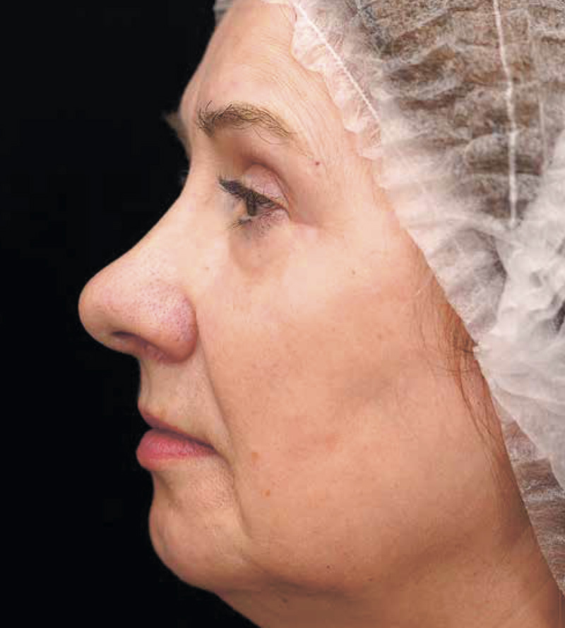 Bioregen + CO₂-лазер