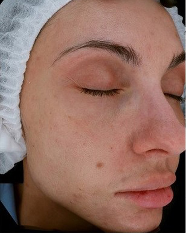 Calecim Professional Serum
