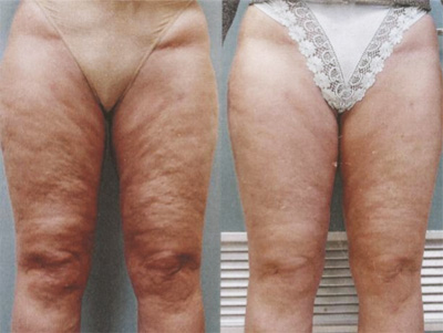 до и после процедуры карбокситерапии, коррекция целлюлита до и после