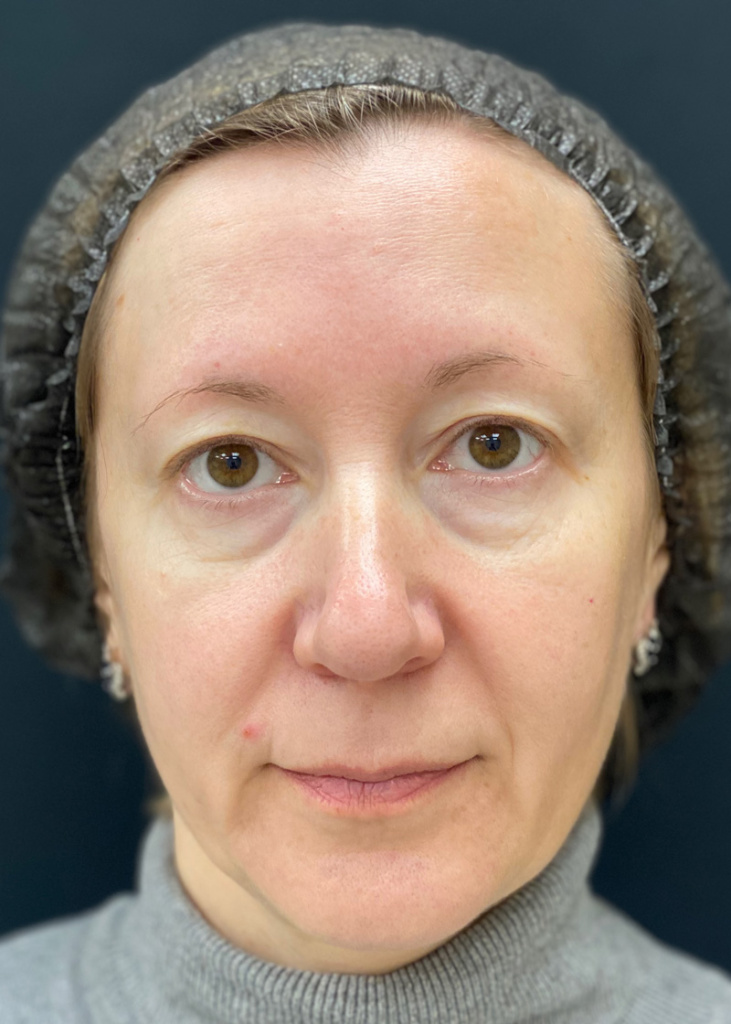 До проведения процедуры с препаратом MIRACOLL fille