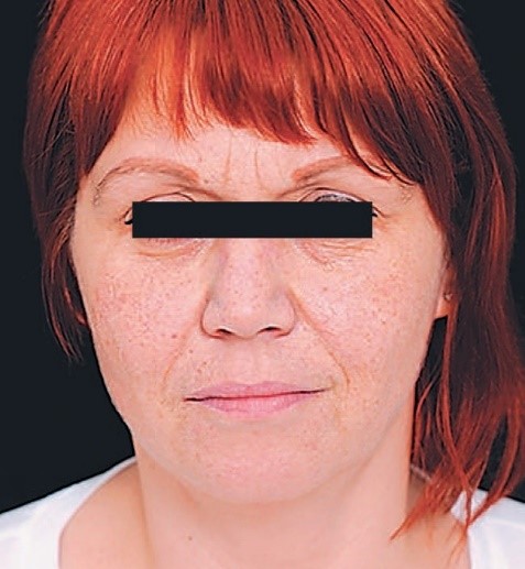 Hyalual До процедуры