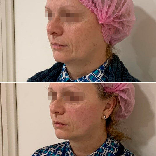 Результаты до/сразу после процедуры Doublo HIFU