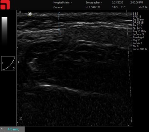 Асимметрия лица – асимметрия SMAS
