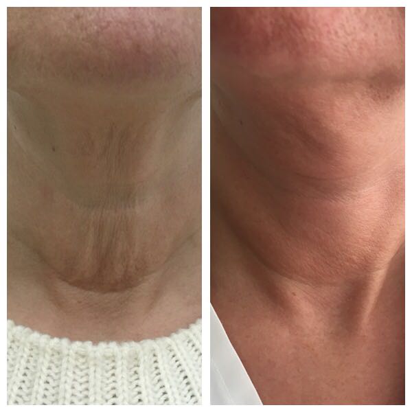 Radiesse_v_razvedenii