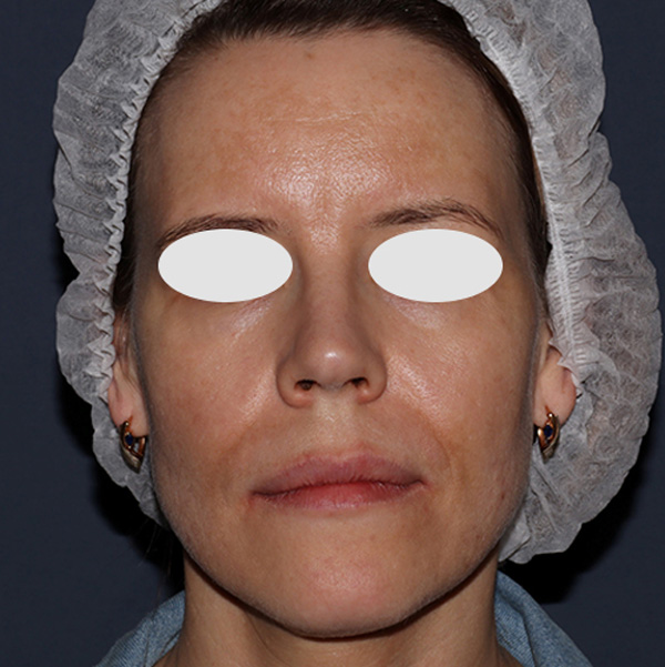 iXtron Fractional