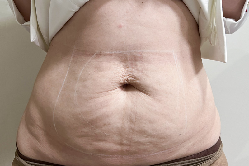 Комбинированный протокол Ulfit + Volnewmer, фото до