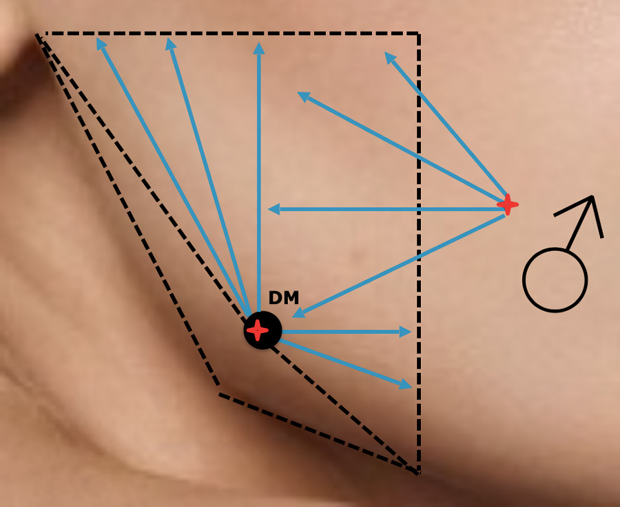 область углов нижней челюсти, разметка, Restylane Perlane