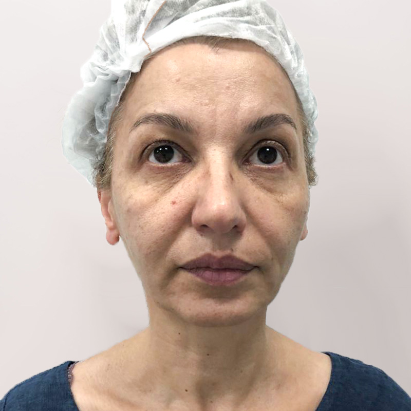 Алла, 32 года. Фото до