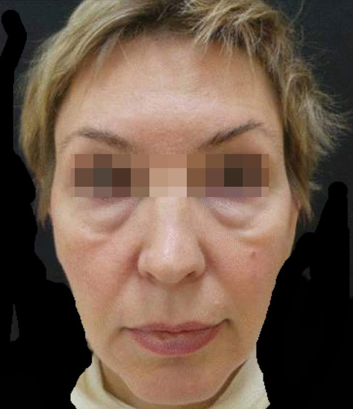 Скульптра (Sculptra) фото до