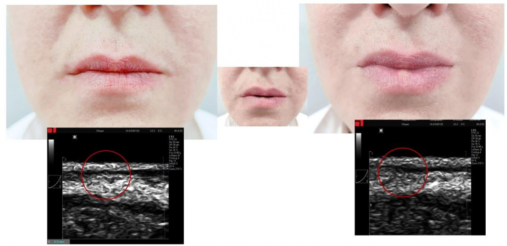 Протокол работы в зоне губ PicoCare