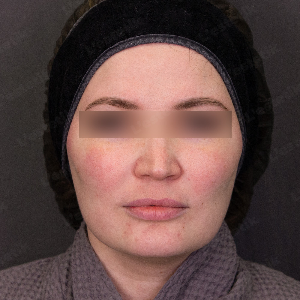 Клинический случай: розацеа