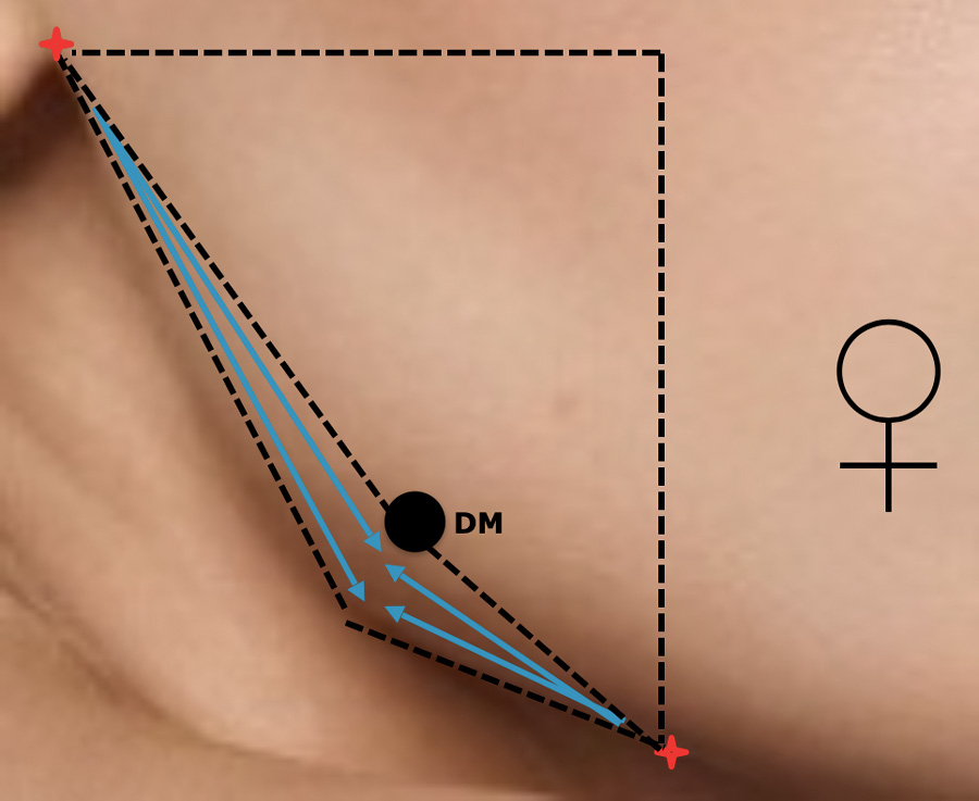 область углов нижней челюсти, разметка, Restylane Perlane
