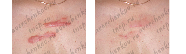Krioterapija rubcy-keloid3-4.jpg