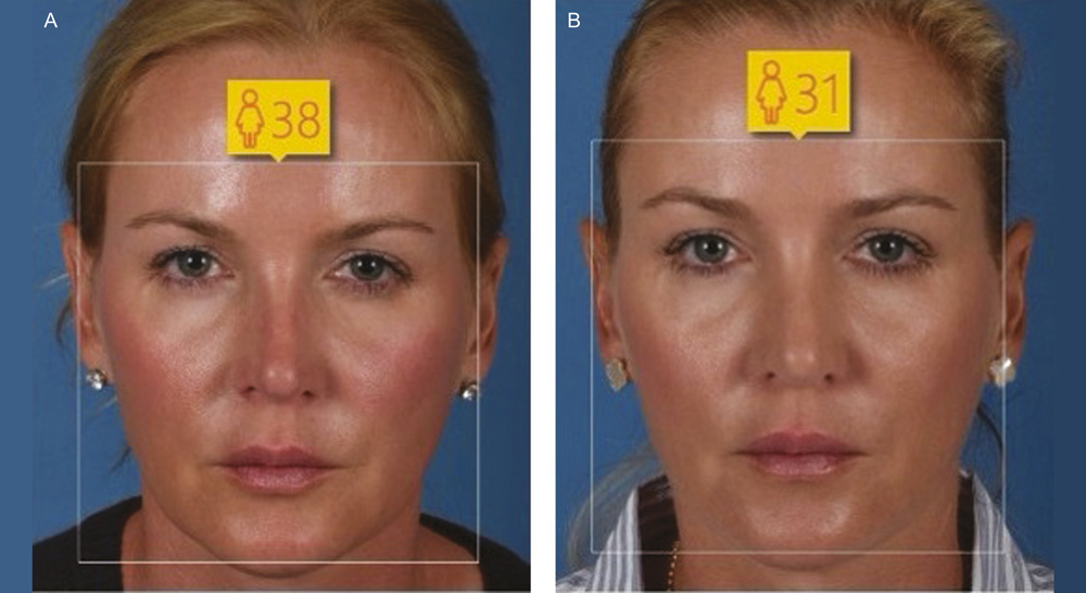 Результаты до и после ринопластики