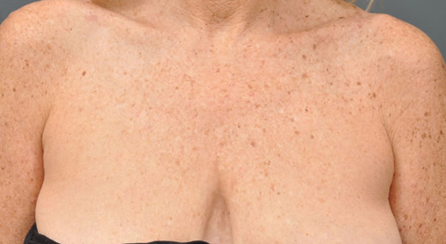 Ultherapy декольте, фото после