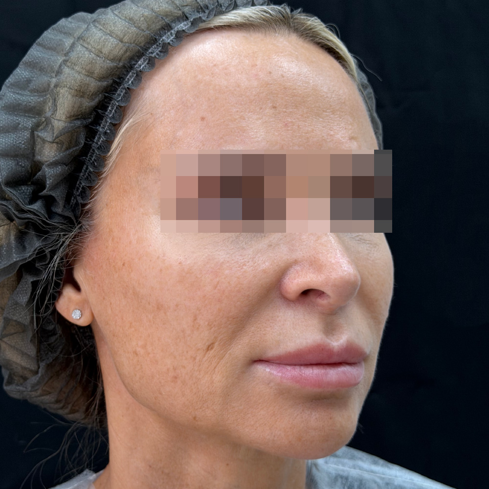 Oligio и Neauvia: фото до