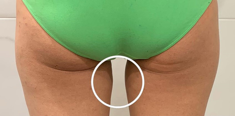 SLIMUS, фото до и после