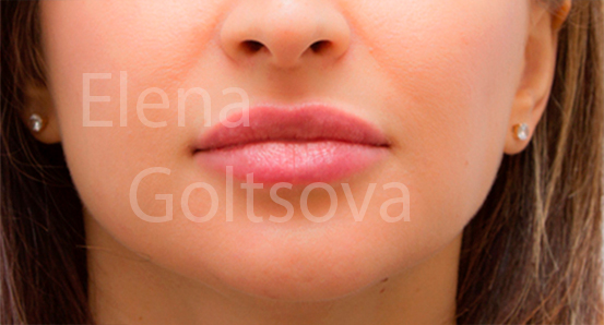 создание объема губ препаратом Etermis 4, фото после процедуры