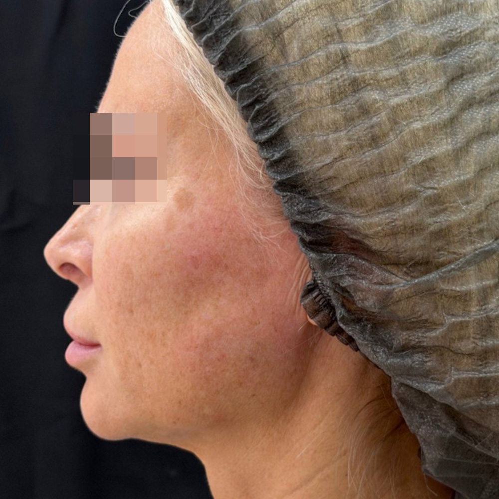 Oligio и Neauvia: фото после