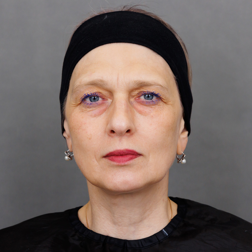 Микроигольчатая RF-терапия Morpheus 8 (InMode): фото до