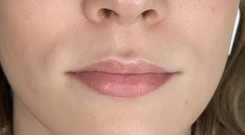 Коррекция губ, препарат Stylage S