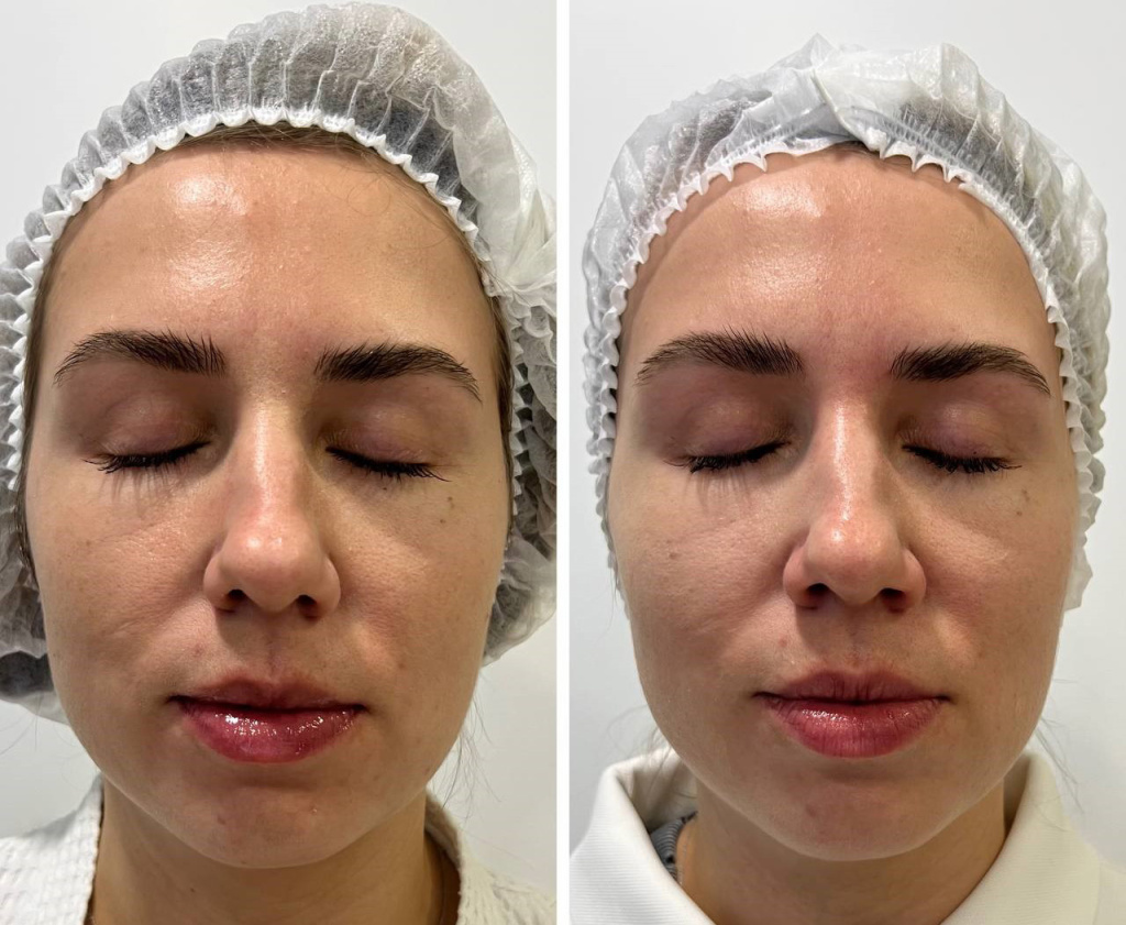 Calecim Professional Serum