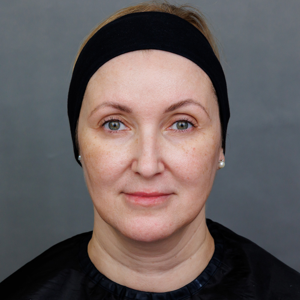 Микроигольчатая RF-терапия Morpheus 8 (InMode): фото после