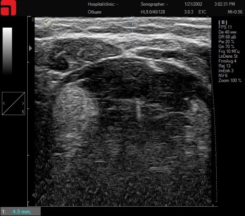 Сканирование субментальной области