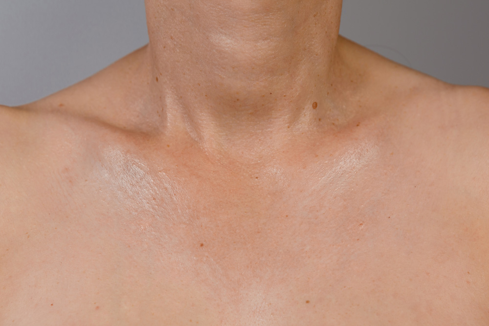 RRS® HA Long Lasting: декольте после