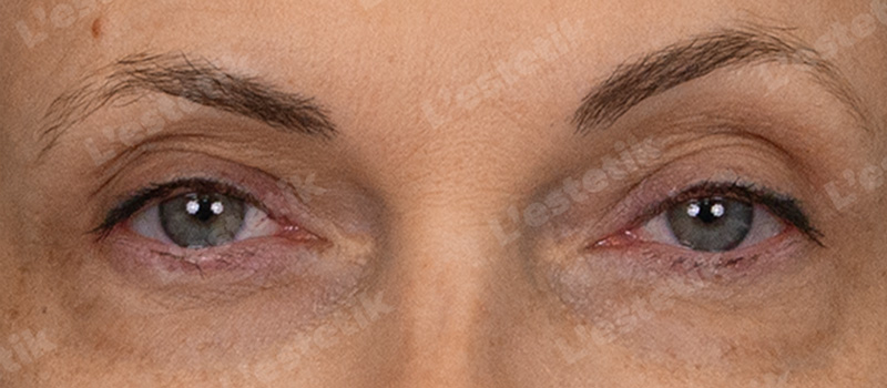 RF-лифтинг Ashley, фото После