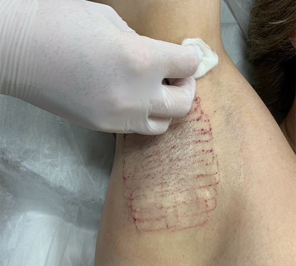 лечение гипергидроза на аппарате MiraDry