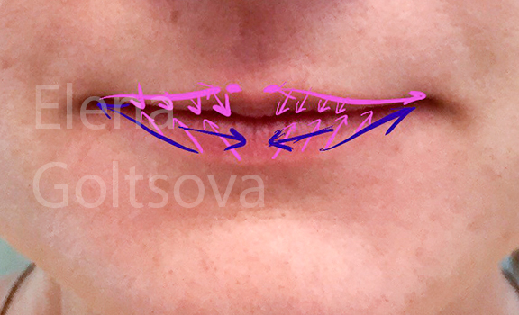 коррекции сложных тонких губ препаратом Belotero Intense, разметка