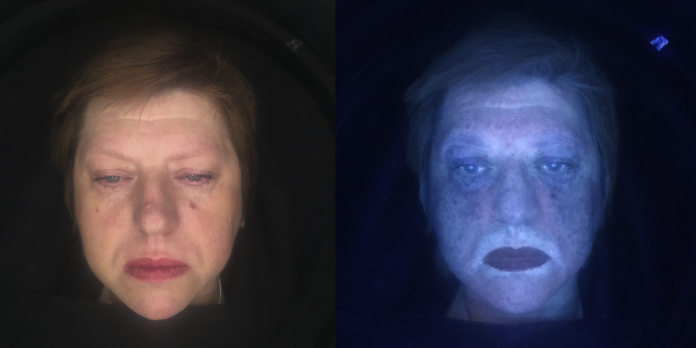 Жирная себорея кожи лица умеренной степени