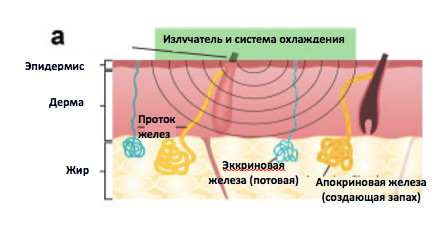 лечение гипергидроза на аппарате MiraDry