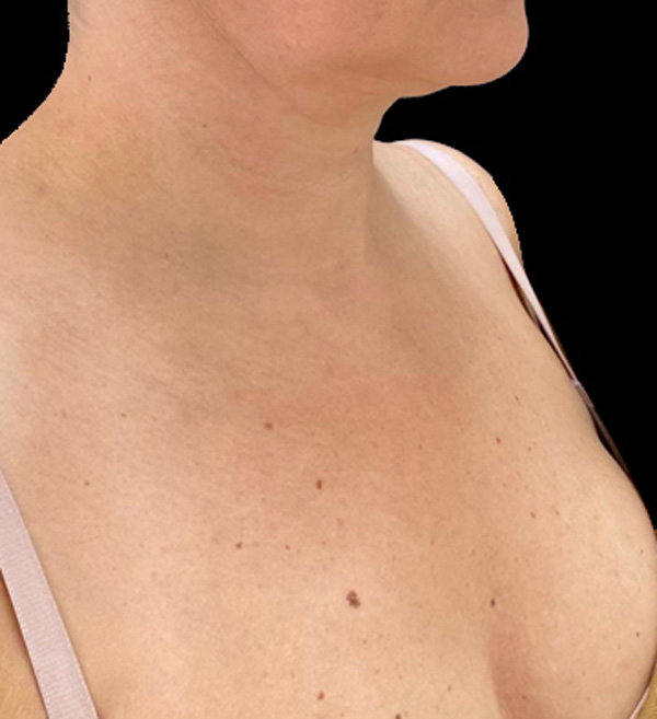 Скульптра (Sculptra) фото после