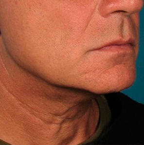 Фото после процедуры Ultherapy posle_Ulthera