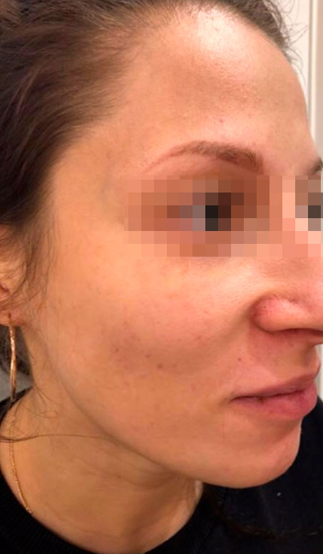 препараты Magiray для коррекции акне