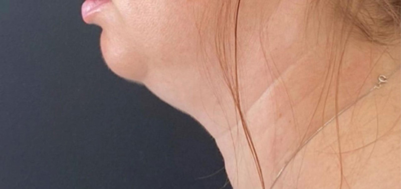 Скульптра плюс криолиполиз