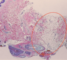 лечение гипергидроза на аппарате MiraDry