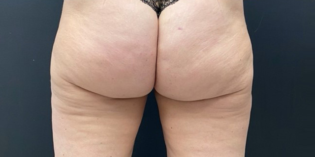 Скульптра, криолиполиз, EMSCULPT