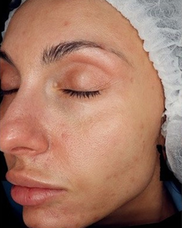 Calecim Professional Serum