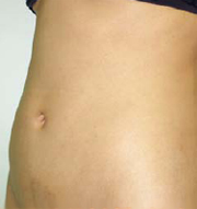 после липосакции