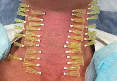 Нити DG-lift 29G