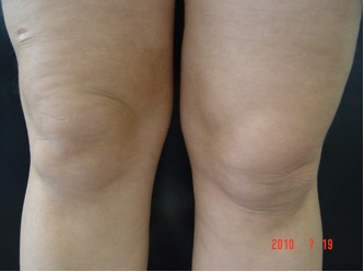 Пациентка с атоничной кожей, избыточными локальными жировыми отложениями в области бедер и коленей с проявлениями целлюлита 2 стадии. Пациентка с атоничной кожей, избыточными локальными жировыми отложениями в области бедер и коленей с проявлениями целлюлита 2 стадии.