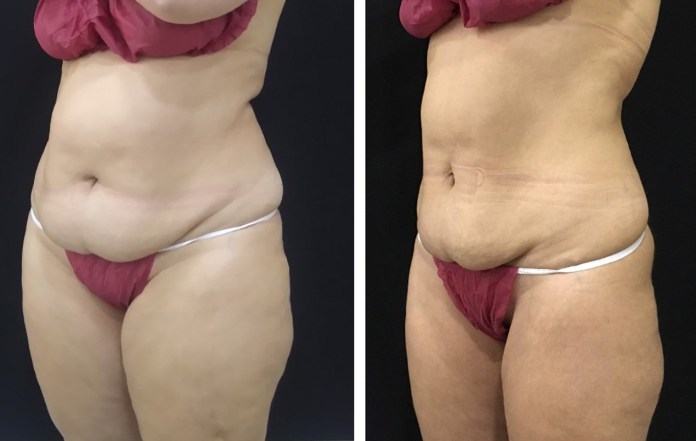 коррекция на аппарате Clatuu, фото до и после