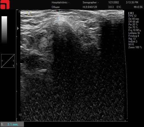 Сканирование в области тела нижнею челюсти (наиболее выступающая часть кости)