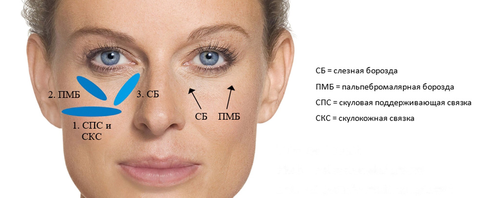 Коррекция подглазничной области