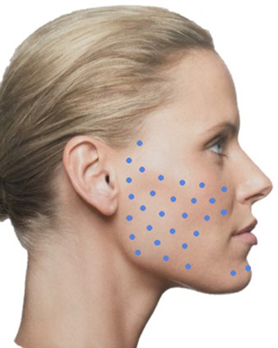 Разведение Ксеомина