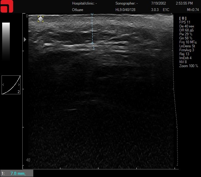 Соединительная ткань при умеренном надавливании в щечной области