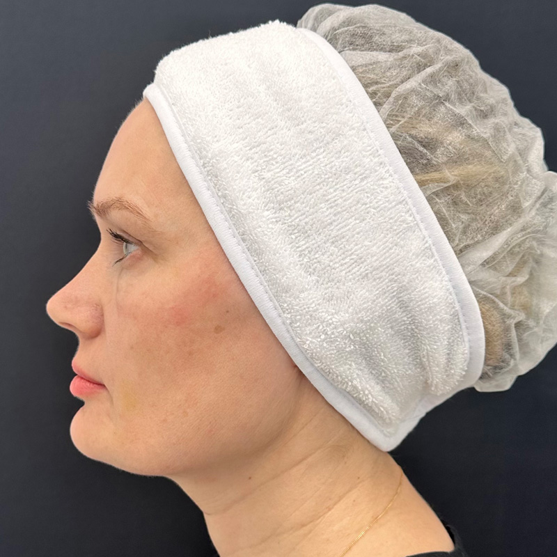 Протокол Bio-Mix Regenyal, фото до